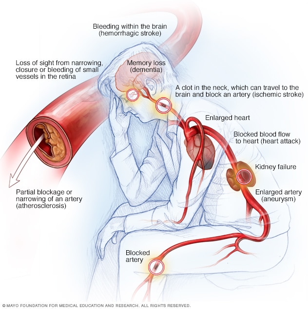 How does high blood pressure affect you physically? How does high blood pressure affect you physically?