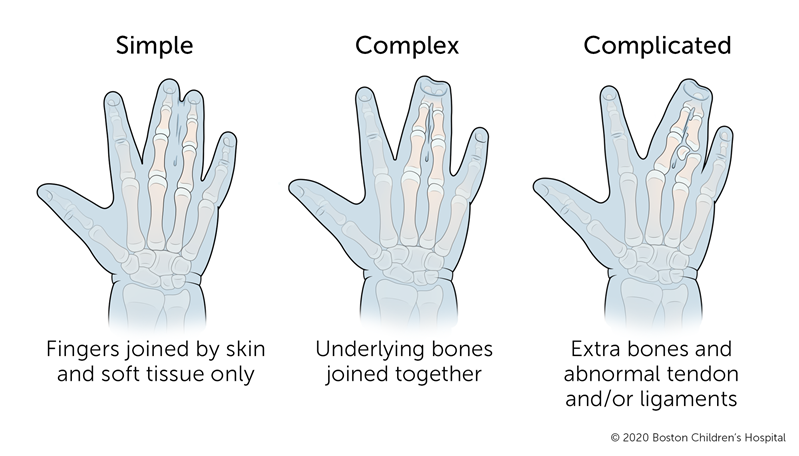 What is the cause of syndactyly?