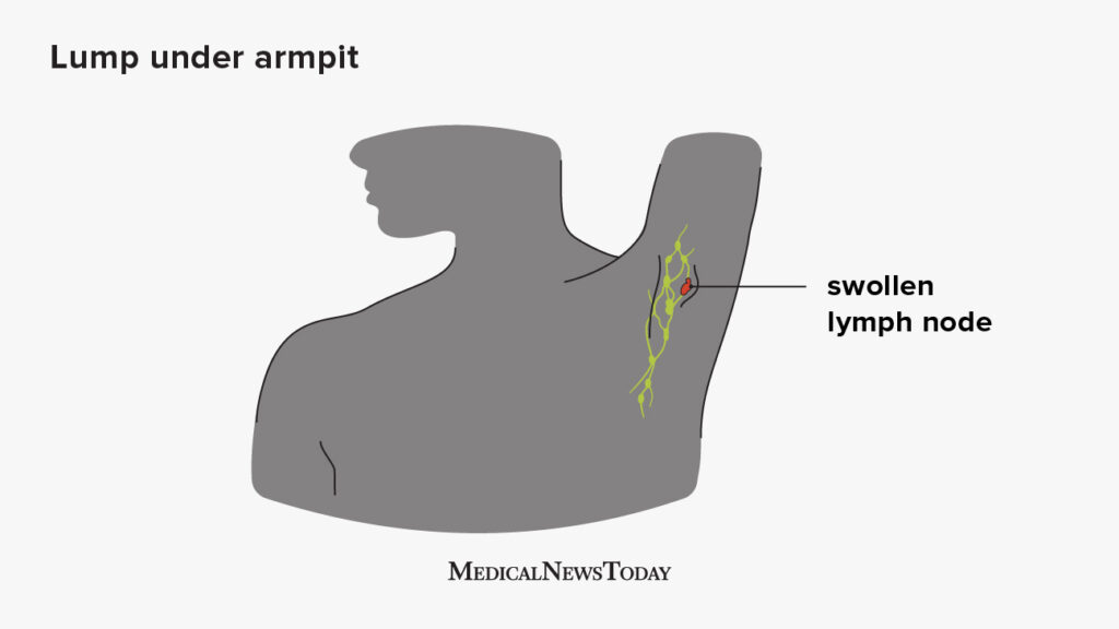 Are swollen lymph nodes in armpit common?