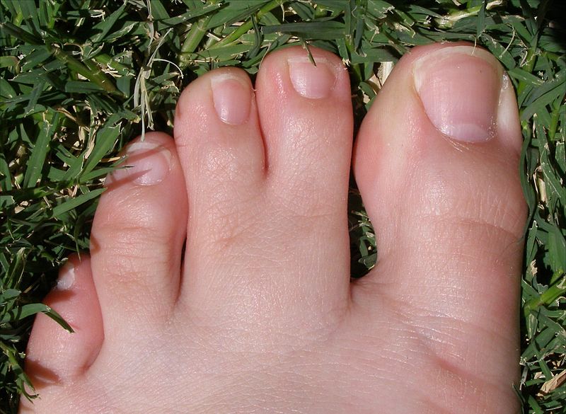 Is it normal to have webbed feet?