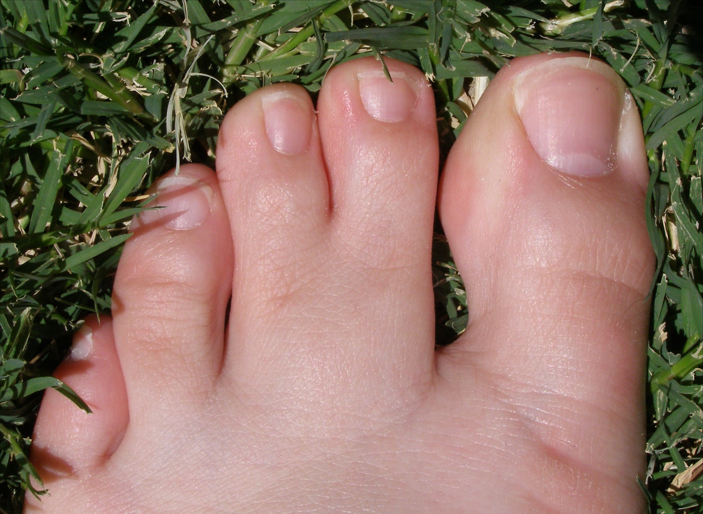 What are webbed toes?