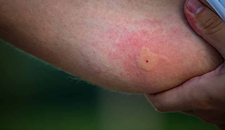 What does a bite from a mosquito look like?