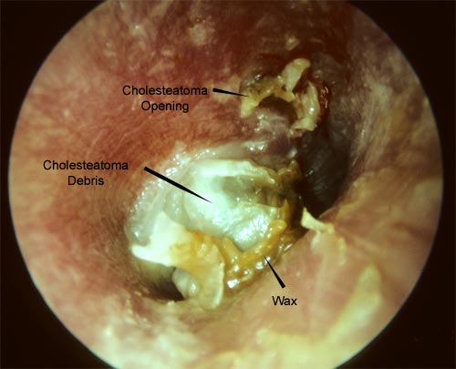 What does a cholesteatoma in the ear look like?