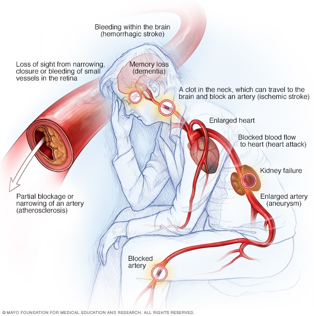 What happens to your heart when you have high blood pressure?